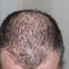 Studie zeigt: Kürbiskernöl hilft gegen genetisch bedingten Haarausfall